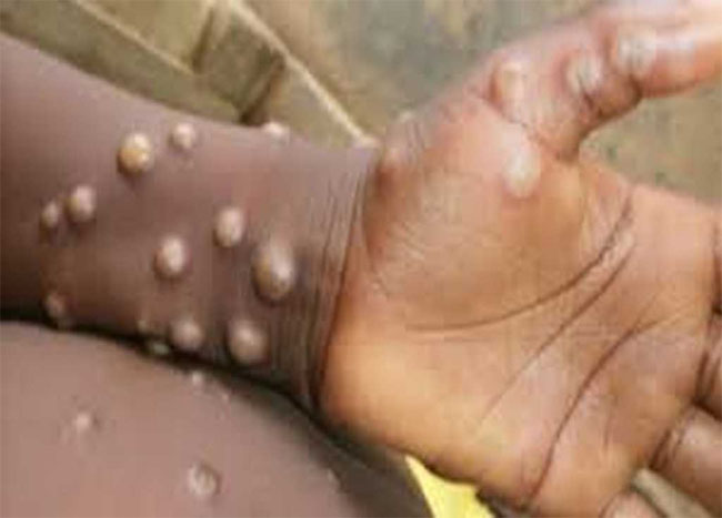 mumbai, First monkeypox patient, Maharashtra